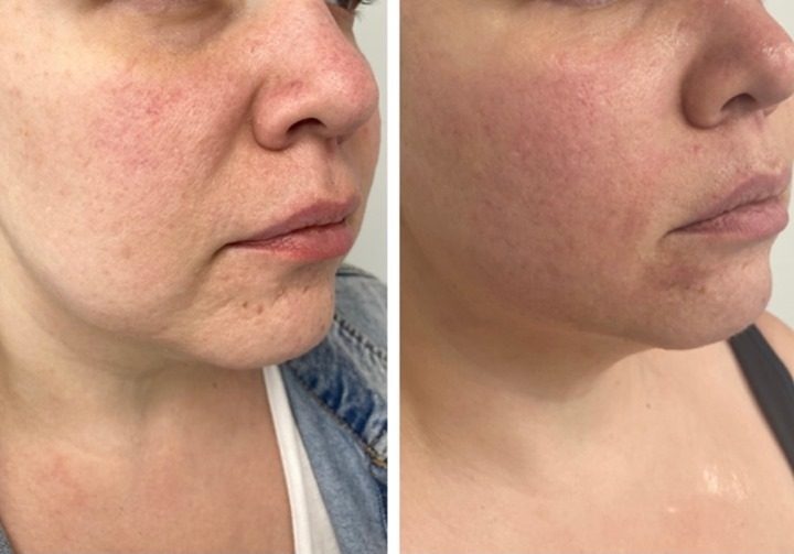 ✨ONLY AFTER 1 SESSION OF MORPHEUS. We have 2 more, so stay tuned for the final results. 😷This treatment is microneedling…