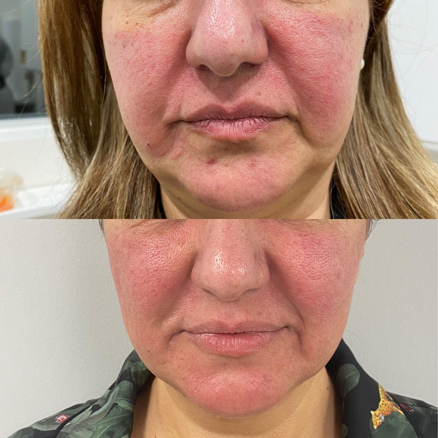 Morpheus8 Collagen and elastin are the key building blocks of glowing, youthful skin. Time, environmental exposure, genetics,