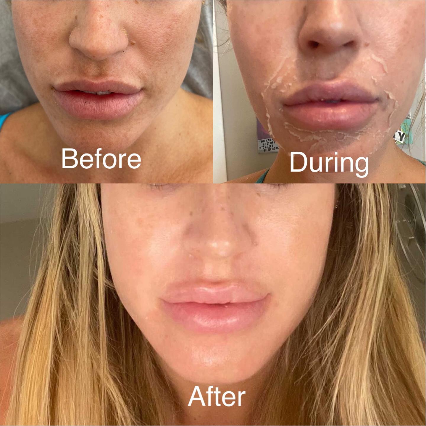 Chemical peel on this babe @themaddiemoore What is the Perfect Derma Peel doing to your skin? After a medical professional ad