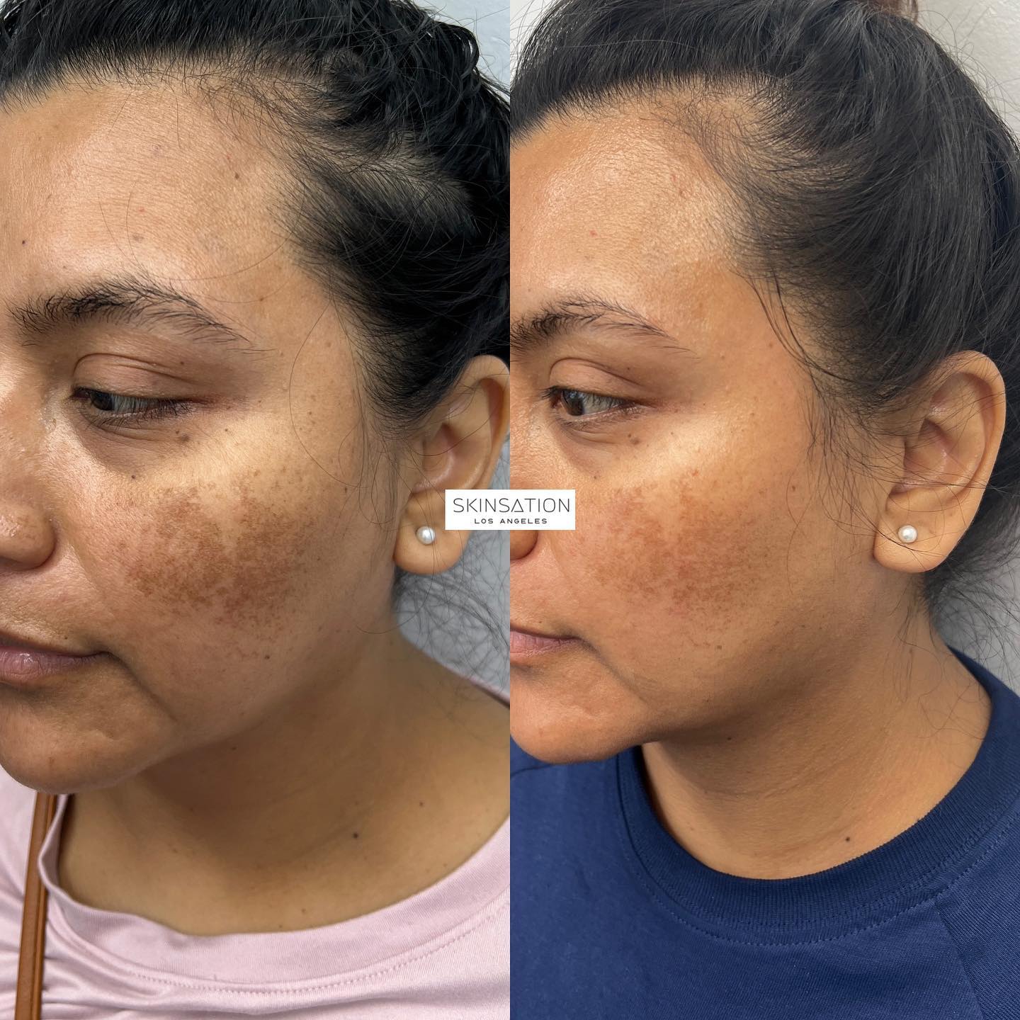 After 1 session of @theperfectdermapeel What is melasma? Melasma is a common skin ailment characterized by hyperpigmentation,