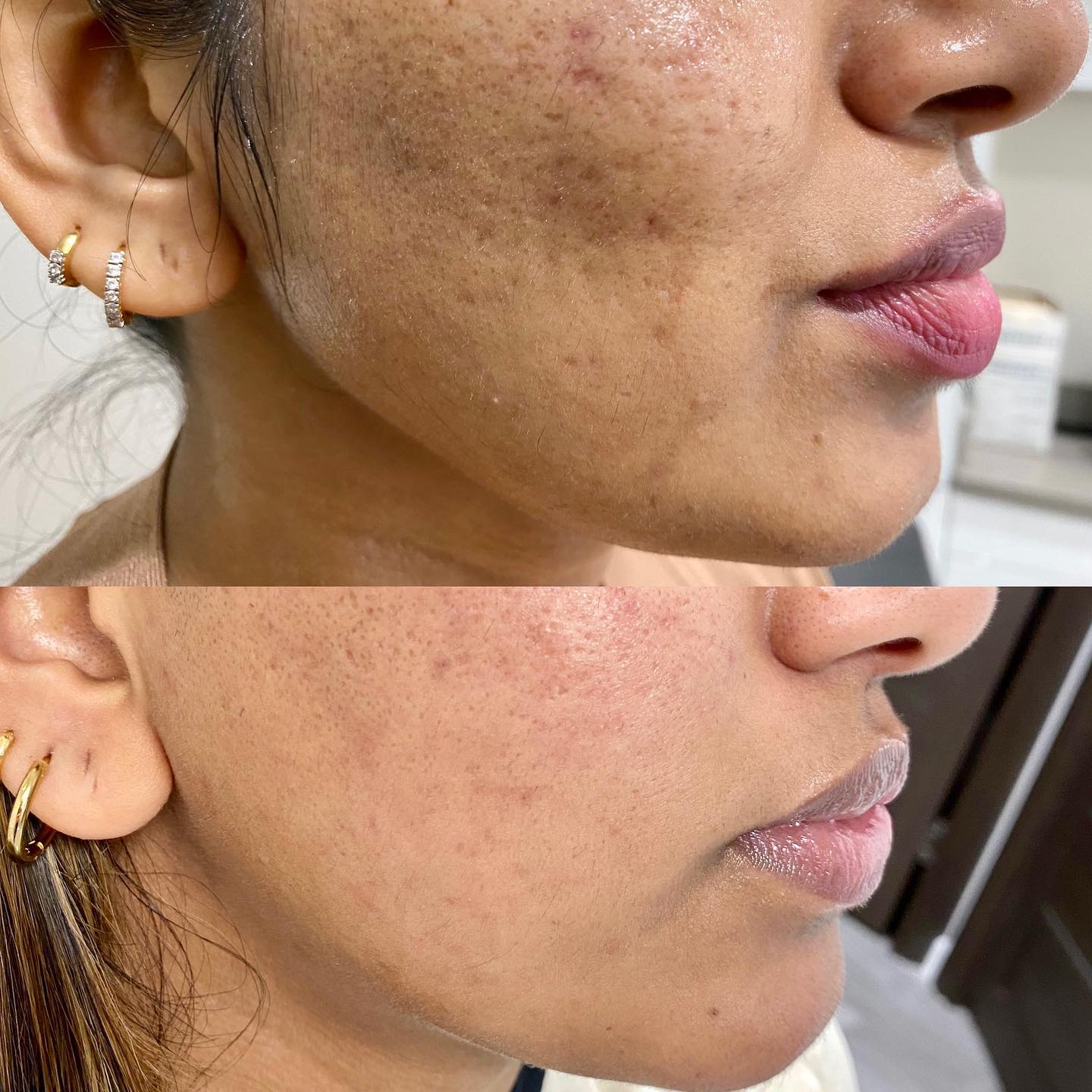 ⭐️Acne scar resurfacing The treatment resurfaces the epidermis through a series of mini micro-channels that will warm these l