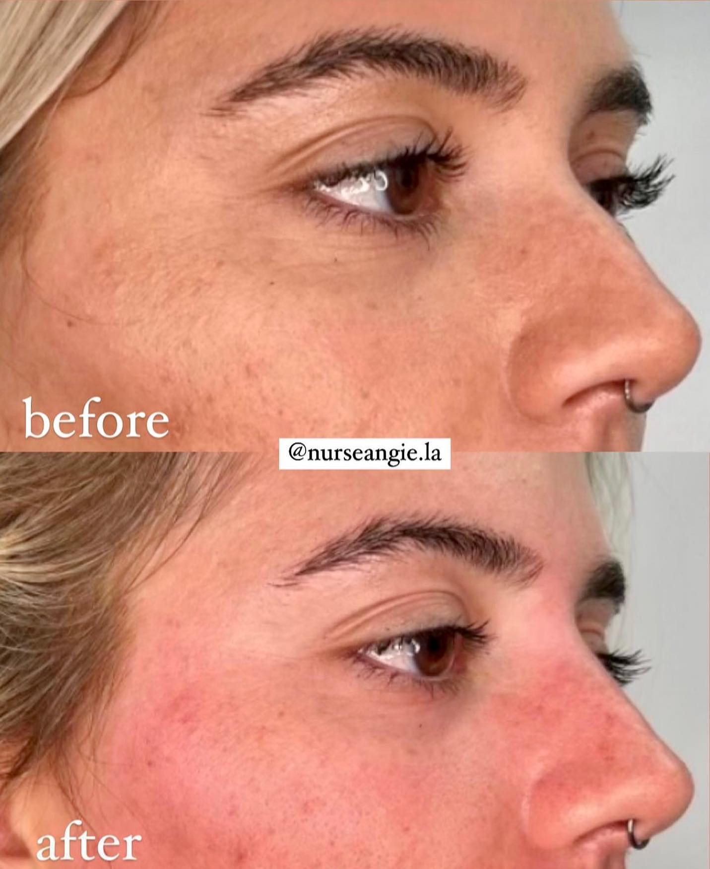 ✨LIQUID NOSE JOB✨ by nurse Angie . . Long lasting results, no downtime. 💲1,200
