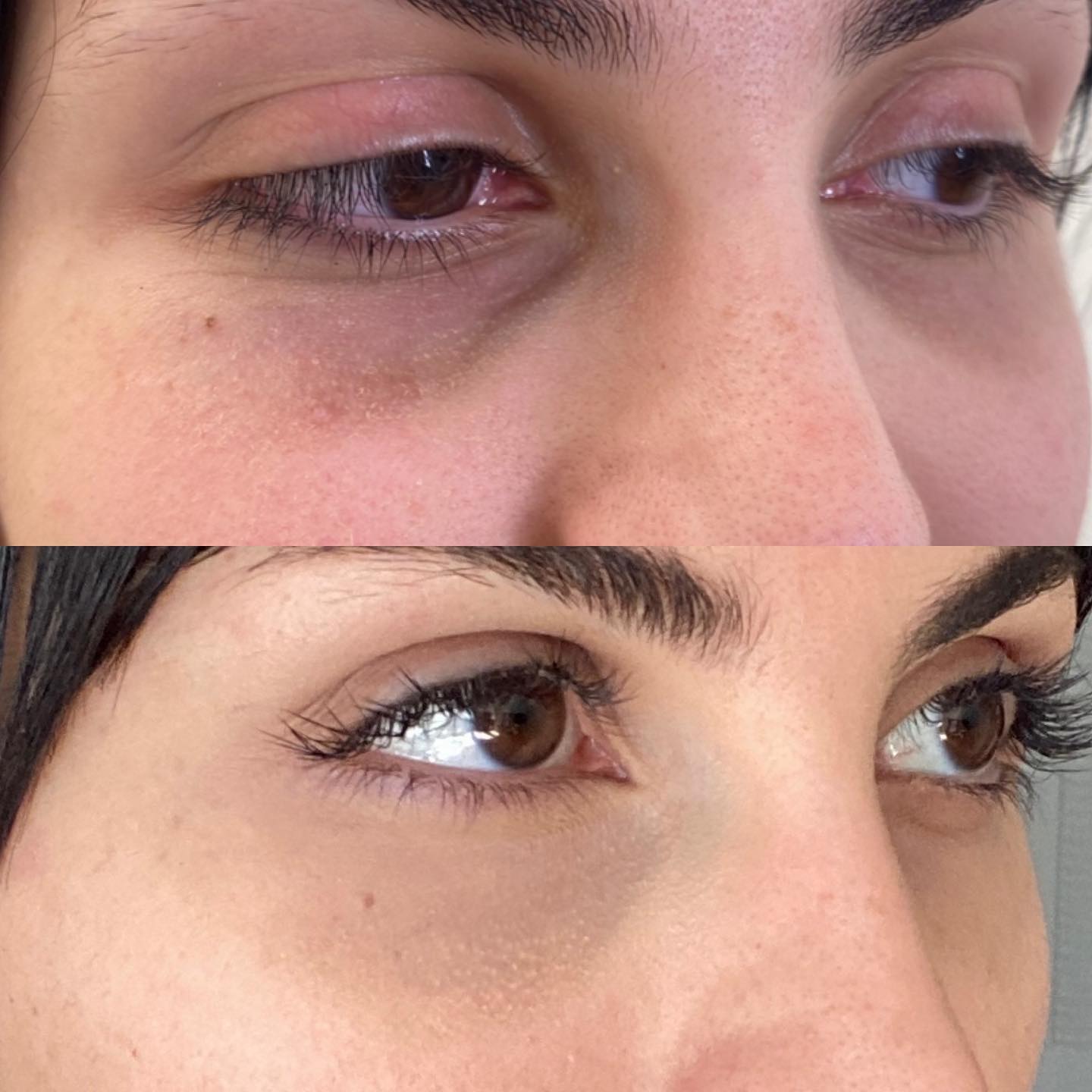 You probably have heard this before, but most people are NOT a good Undereye filler candidate. While some fillers, like Resty