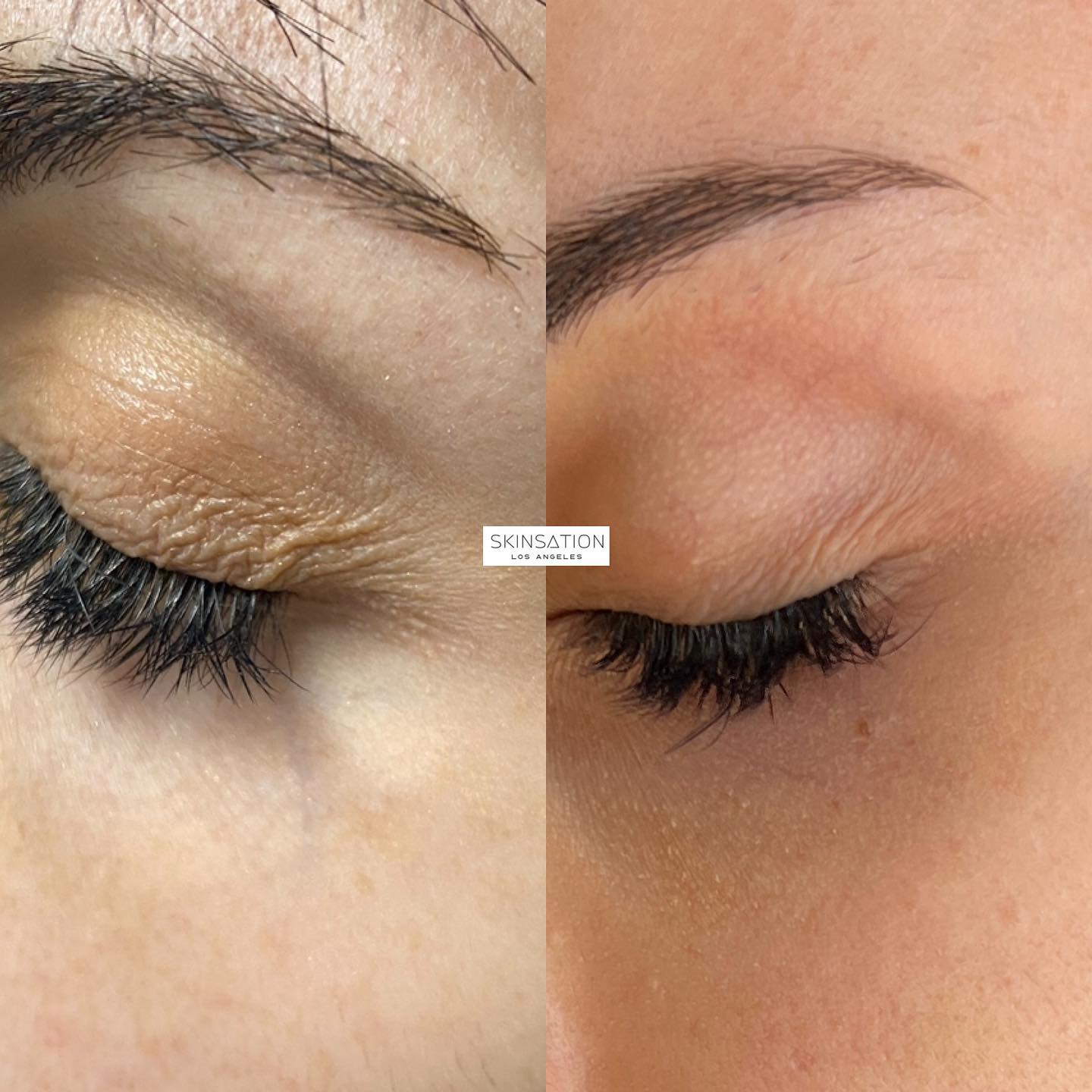 Results from 2 sessions of morpheus8 prime for undereyes. Client consulted with a plastic surgeon for upper blepharoplasty bu