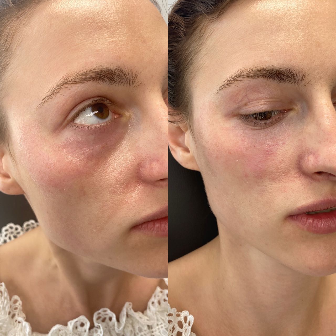 UNDER EYE FILLERS: Best candidates for under eye filler are patients who have true hollows or depressions under the eye, and
