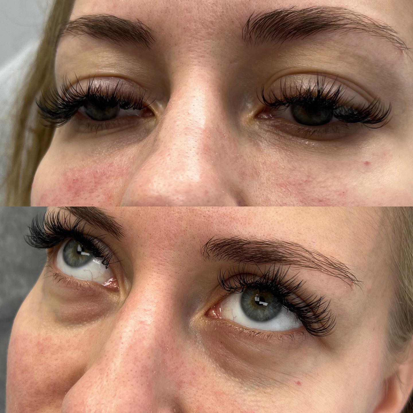 Treatment: Tear trough filler Purpose: to add volume beneath the eyelid Ideal candidate: people that actually have hollowing