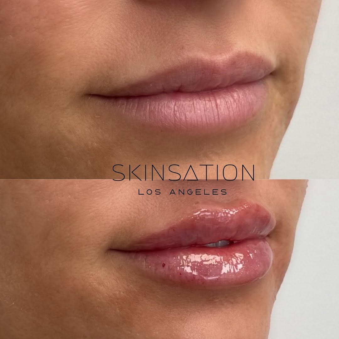 A beautiful, subtle look for our gorgeous patient✨ We offer a variety of HA filler brands including @restylaneusa @juvederm @