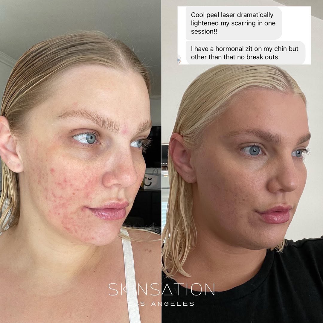CO2 CoolPeel Laser - helps reduce hyperpigmentation and acne scars, superficial lines and wrinkles. Results are seen after a