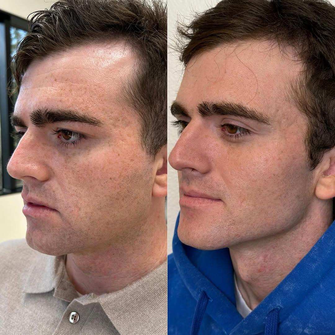 This season, CO2 laser is the top choice for men. It enhances skin quality without changing facial features, requires no need
