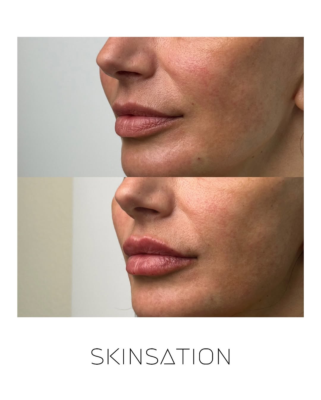 Lip filler is designed to enhance your natural shape, not change it. We focus on symmetry, hydration, and subtle volume to cr