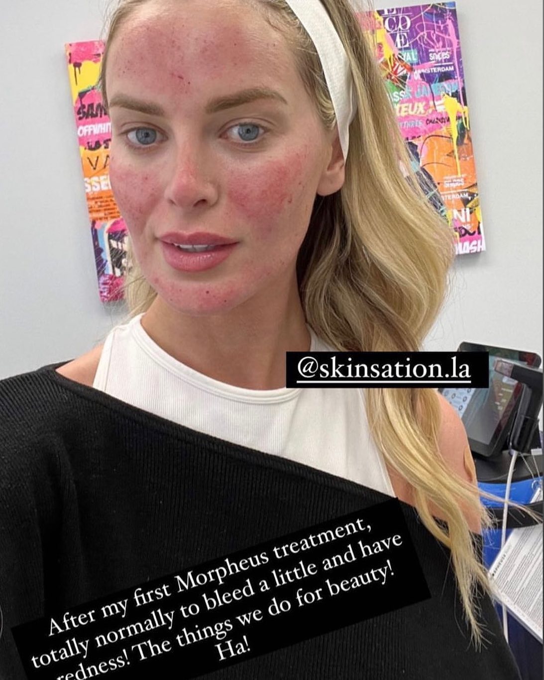 @iamkatyjohnson, a Skinsation LA client featured on Instagram
