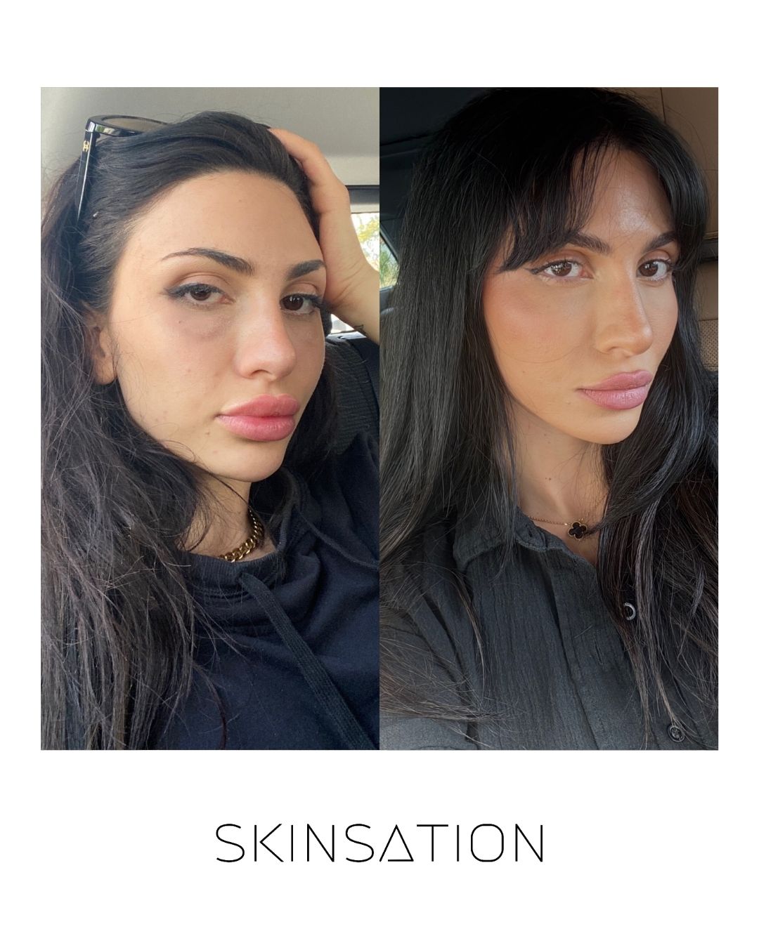 Skinsation LA 90-day skin transformation — clearer, brighter complexion