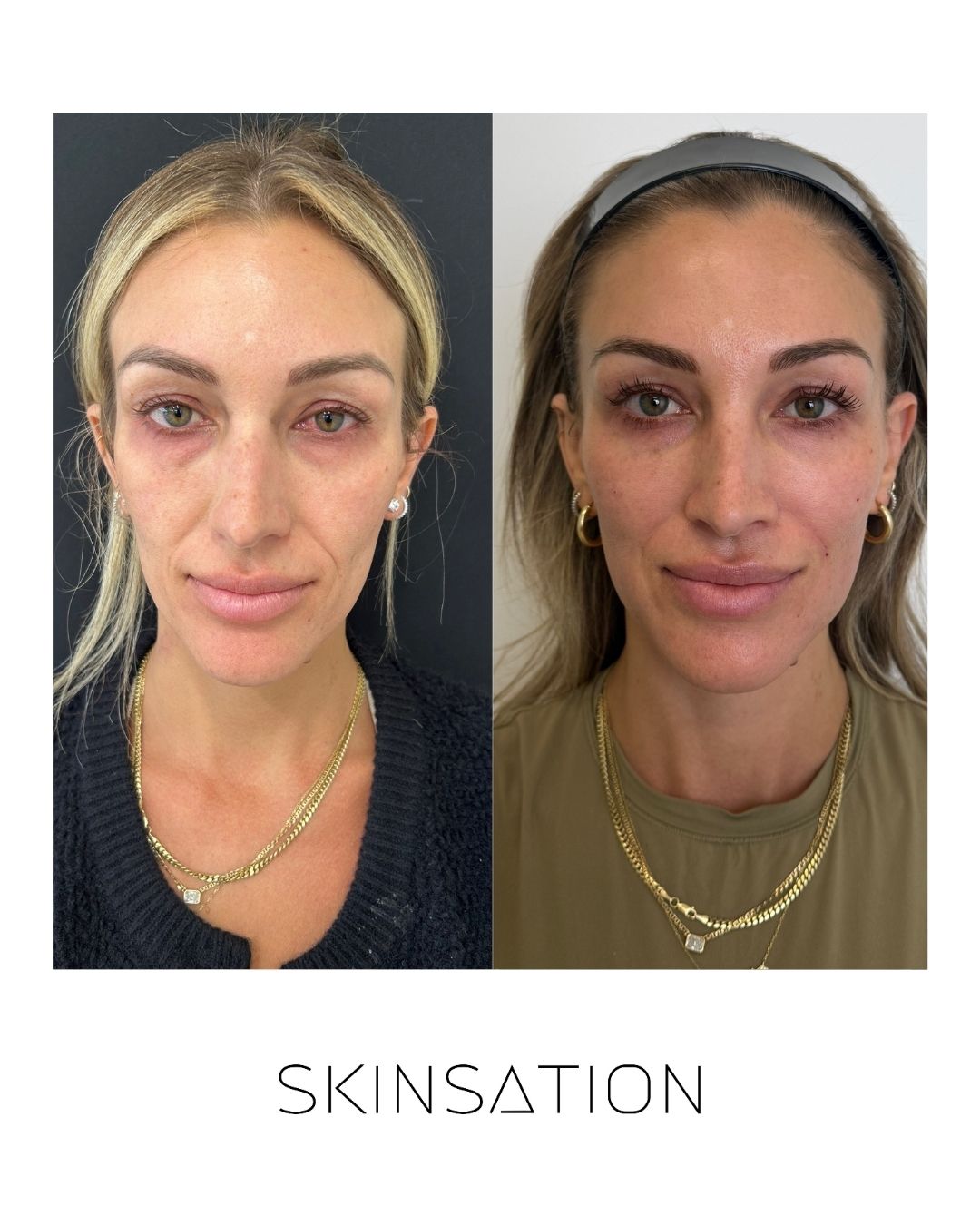 Skinsation LA 90-day skin transformation — even tone and reduced redness
