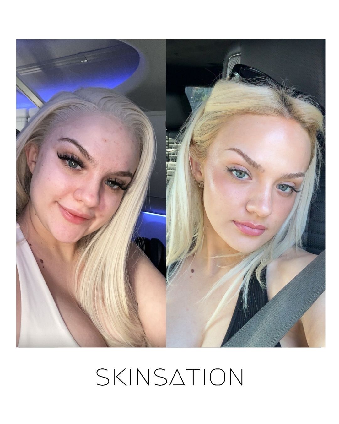 Skinsation LA 90-day skin transformation — restored glow and clarity