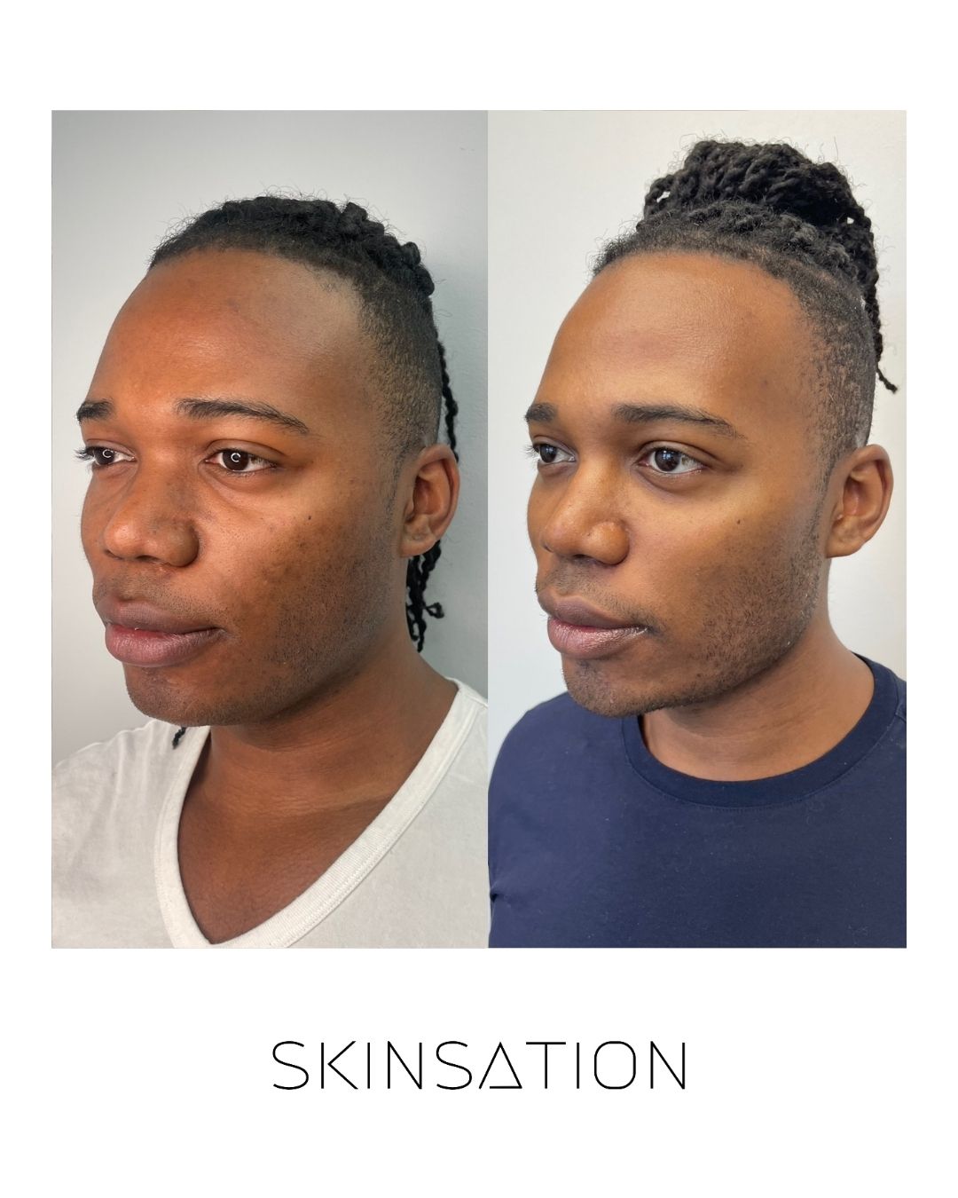 90-day skin transformation texture improvement male