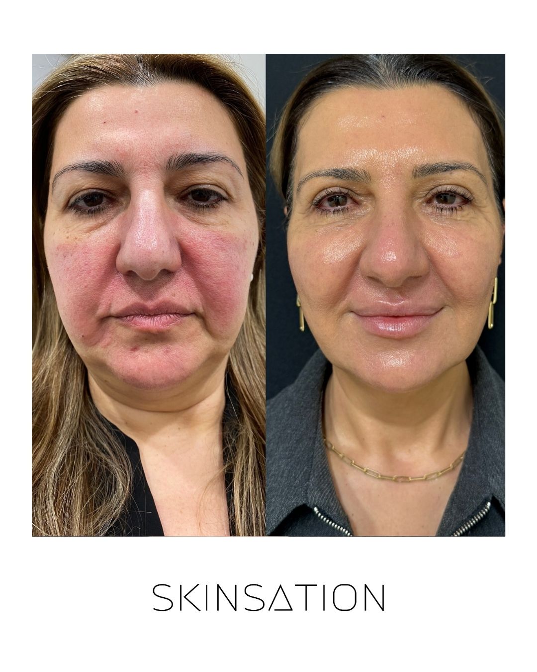 Skinsation LA 90-day skin transformation — smoother texture and lifted skin