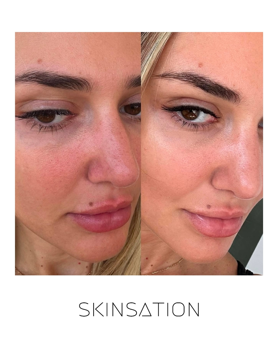 Skin treatment before and after result 20